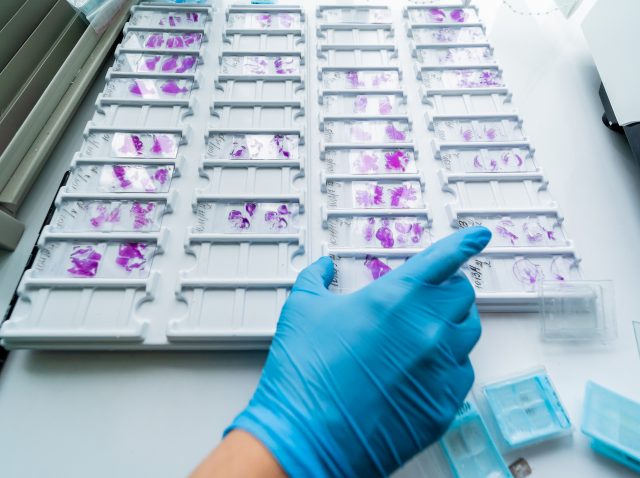 Tumor markers screening Tumor markers screening