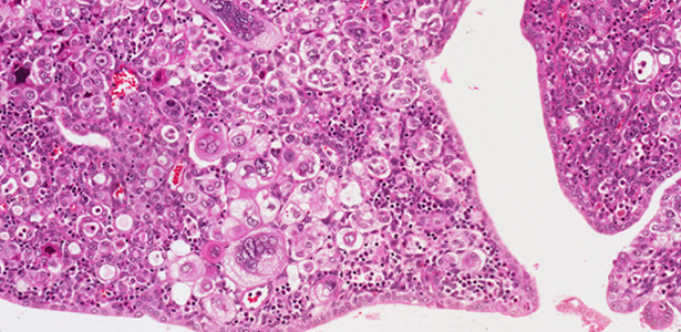 Womb cancer treatment Womb cancer treatment