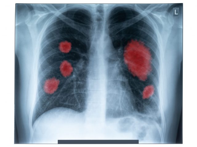 X-Ray image of human chest for a medical diagnostic. Coronavirus-COVID-19. Epidemic virus 2019-nCoV Respiratory Syndrome. Medicine concept. X-Ray image of human chest for a medical diagnostic. Coronavirus-COVID-19. Epidemic virus 2019-nCoV Respiratory Syndrome. Medicine concept.