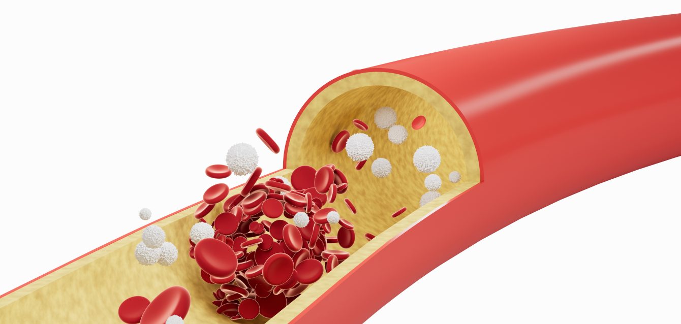 Vasculitis treatment market