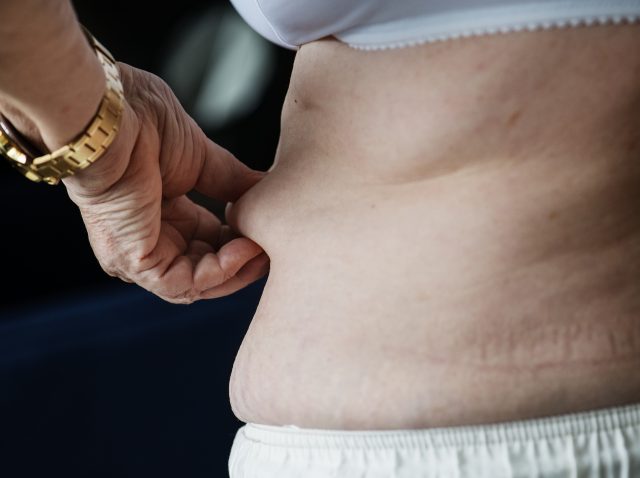 Anti-obesity therapy Anti-obesity therapy