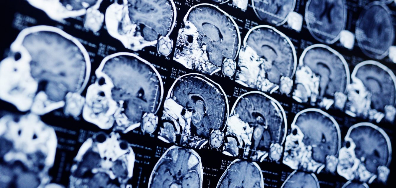 DNA repair defect DNA repair defect