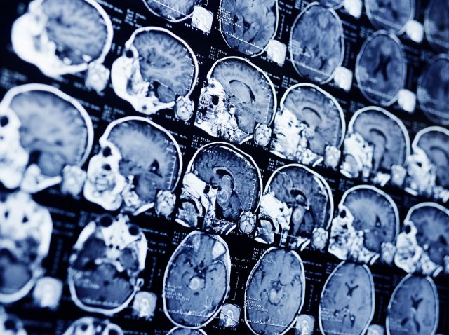 DNA repair defect DNA repair defect