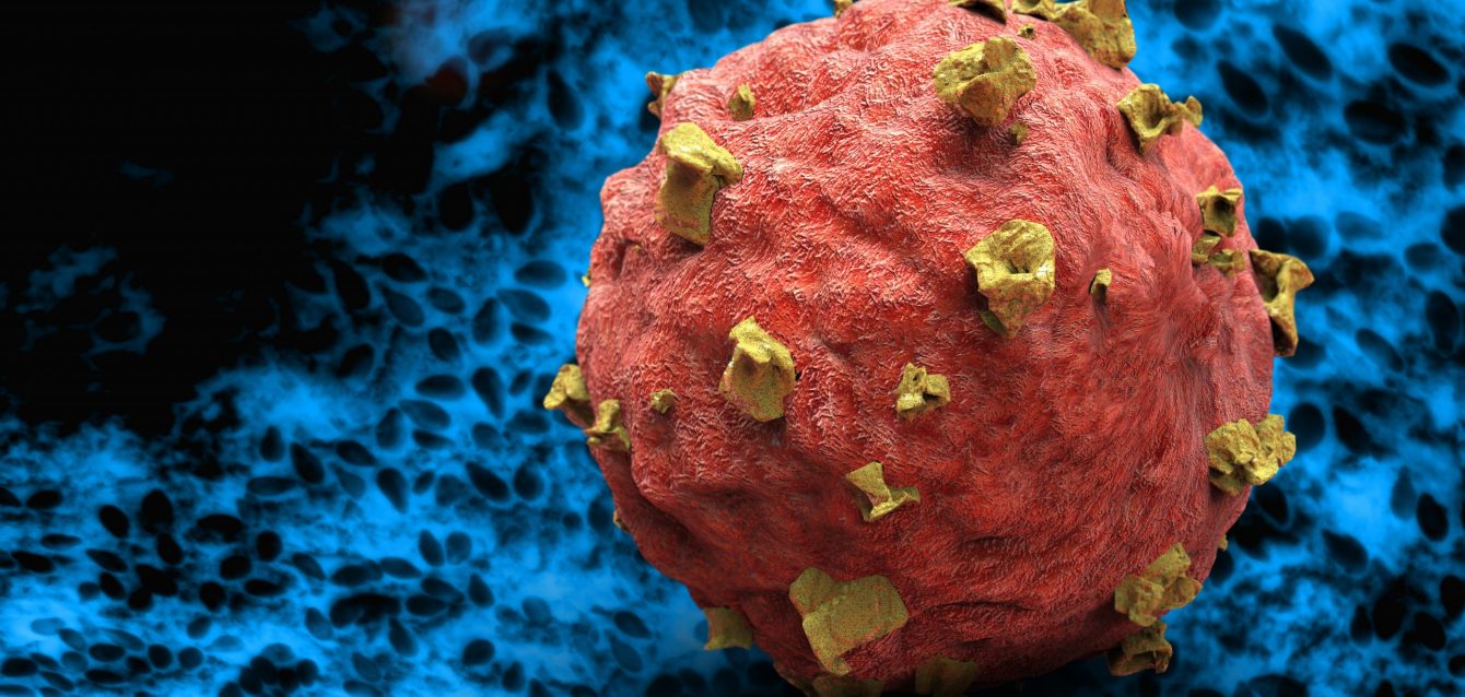 Metastatic pancreatic cancer