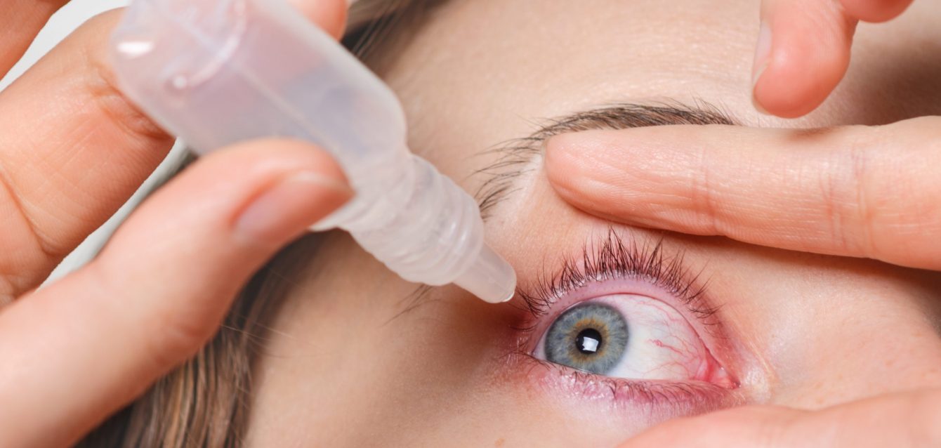 Close up shot of female pours drops in red eye, has conjuctivitis or glaucoma, bad eyesight and pain. Eyes pain treatment concept. Woman cures red blood eye Close up shot of female pours drops in red eye, has conjuctivitis or glaucoma, bad eyesight and pain. Eyes pain treatment concept. Woman cures red blood eye