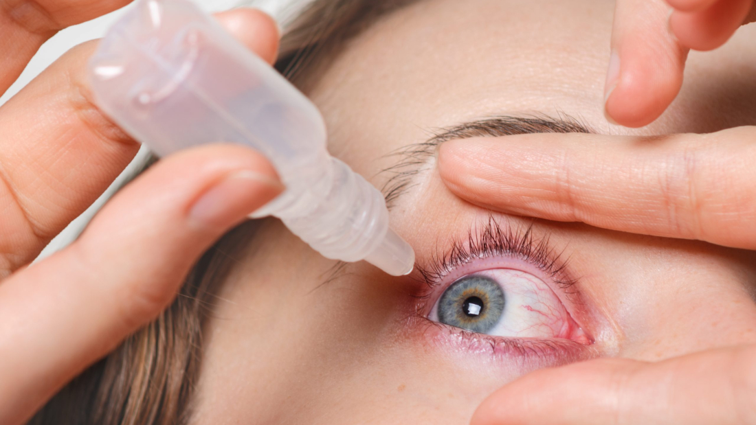 Primer plano de mujer vierte gotas en ojo rojo, tiene conjuctivitis o glaucoma, mala vista y dolor. Concepto de tratamiento del dolor de ojos. Mujer cura ojo rojo