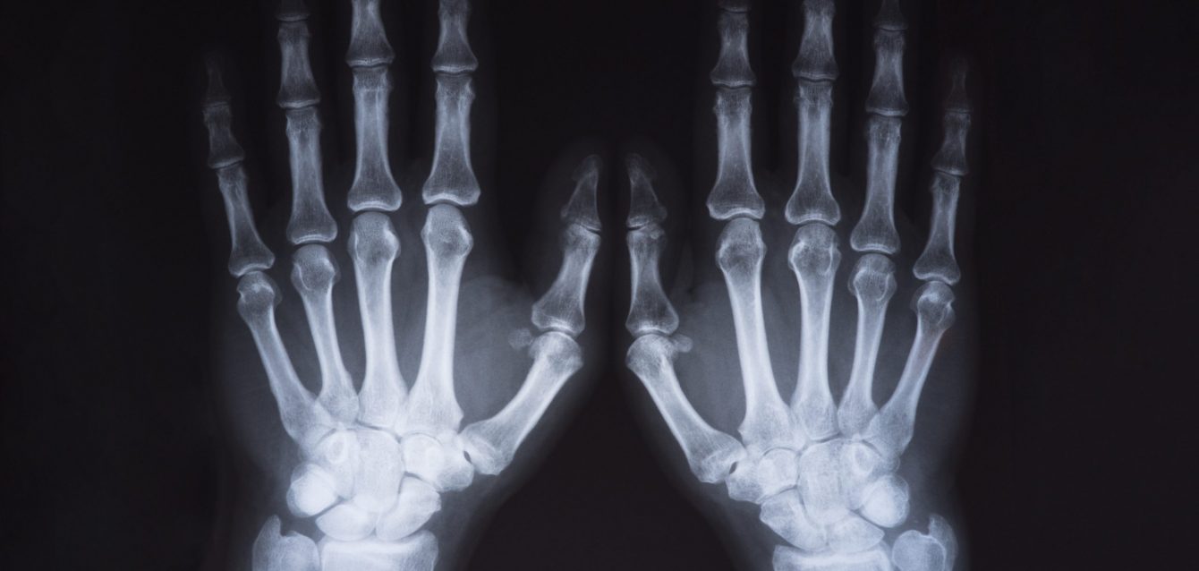 Medical x ray hands image Medical x ray hands image