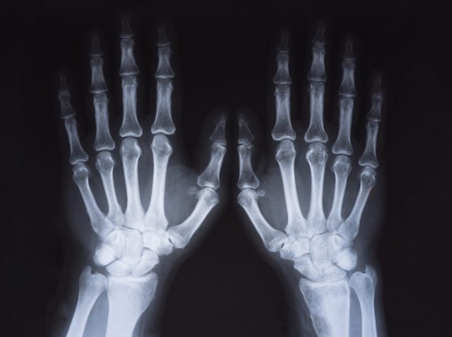 Medical x ray hands image