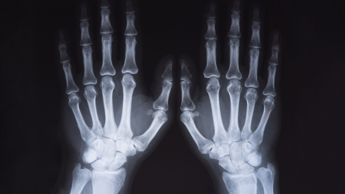 Imagen médica de rayos X de las manos