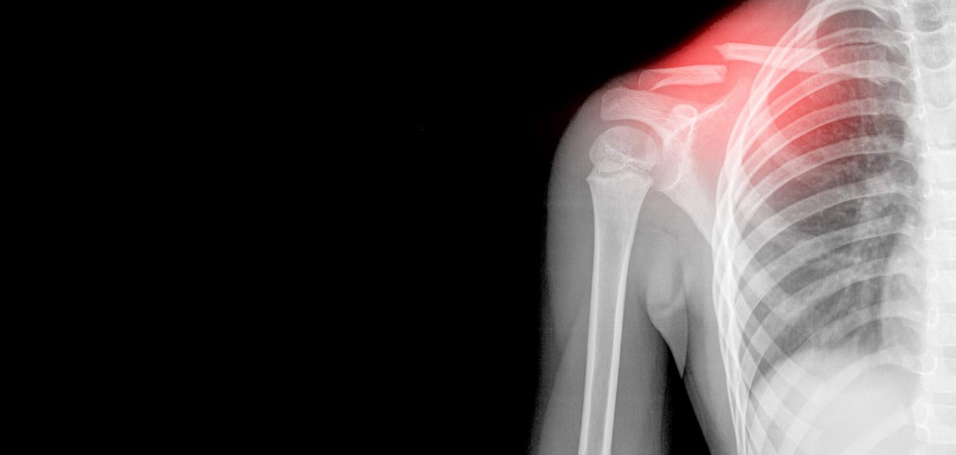 Psoriatic arthritis treatment Psoriatic arthritis treatment