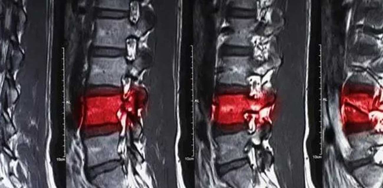 Spinal Cord Injuries Xray Image | New Stem Cell-Based I Tiral