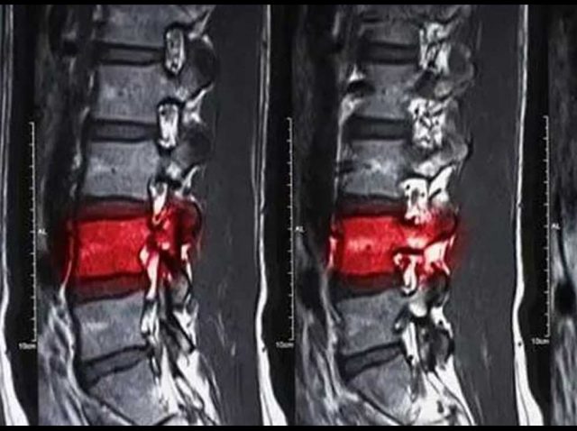 Spinal Cord Injuries Xray Image | New Stem Cell-Based I Tiral