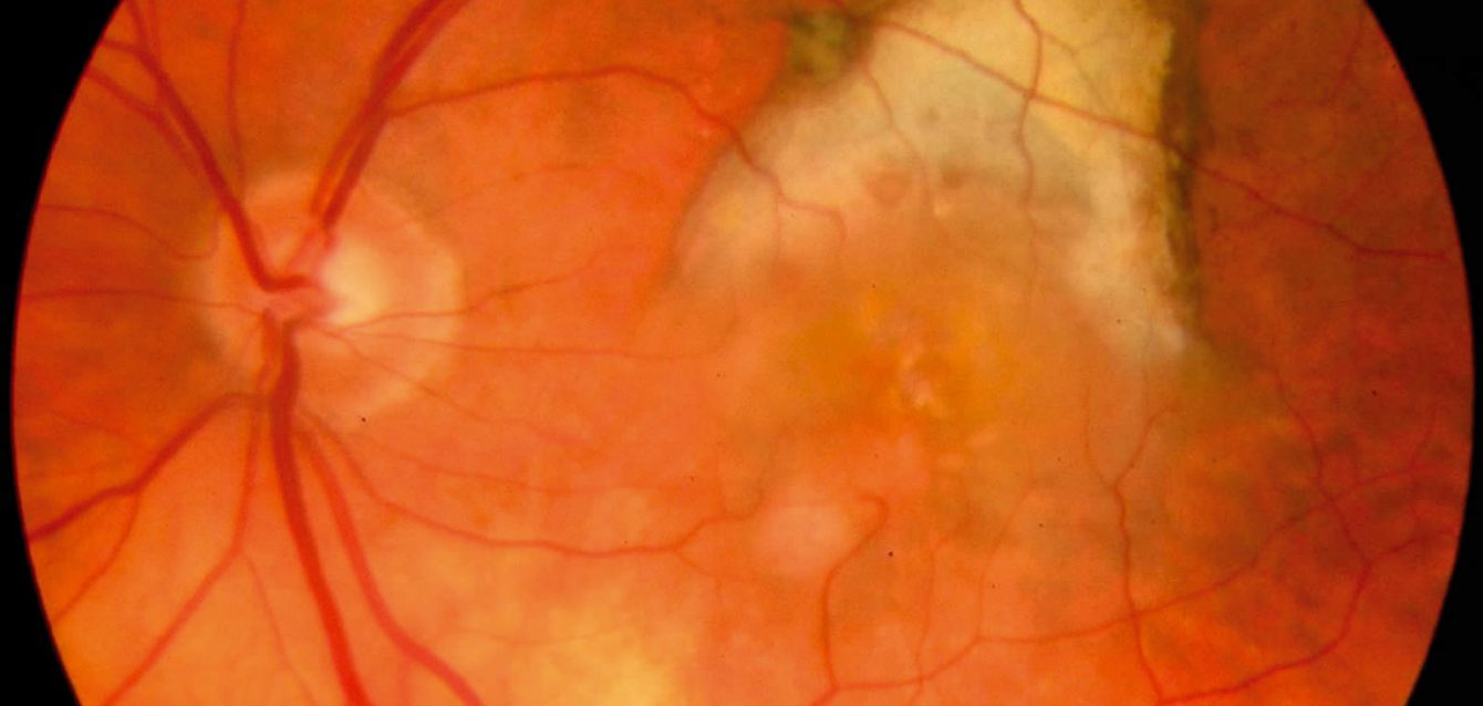 Age-related macular degeneration Age-related macular degeneration