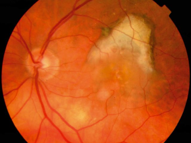 Age-related macular degeneration