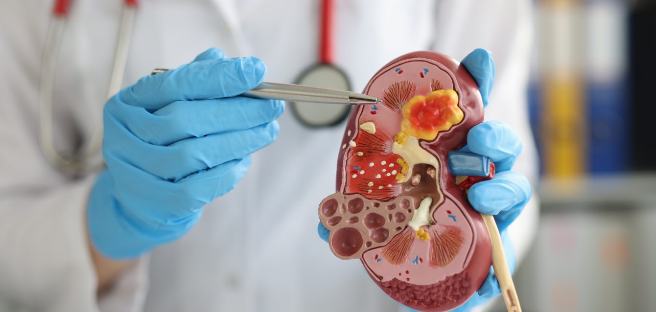 chronic kidney disease