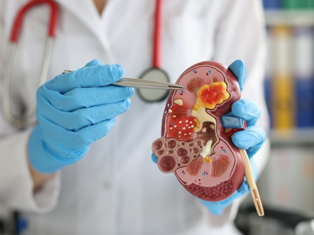 chronic kidney disease