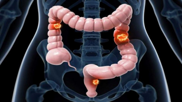 Colorectal Cancer