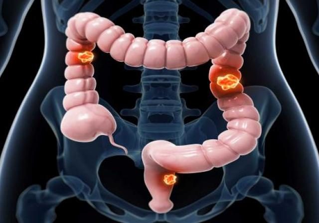 Colorectal Cancer