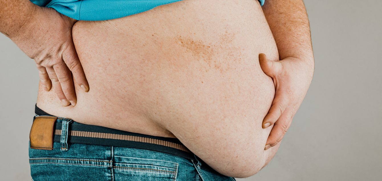 Problemas de salud relacionados con la obesidad