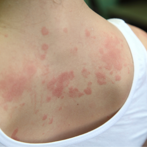 Chronic Spontaneous Urticaria