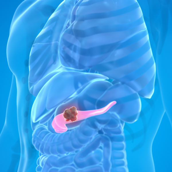 Exocrine Pancreatic Insufficiency (EPI)