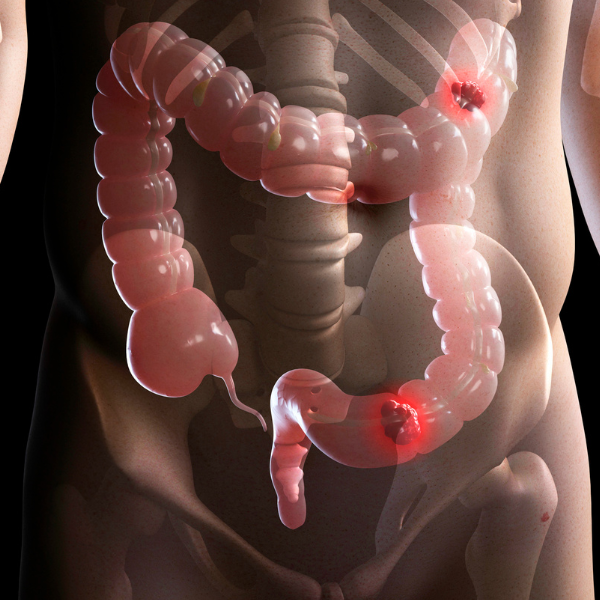 Active-Studies-10-1 Inflammatory Bowel Disease