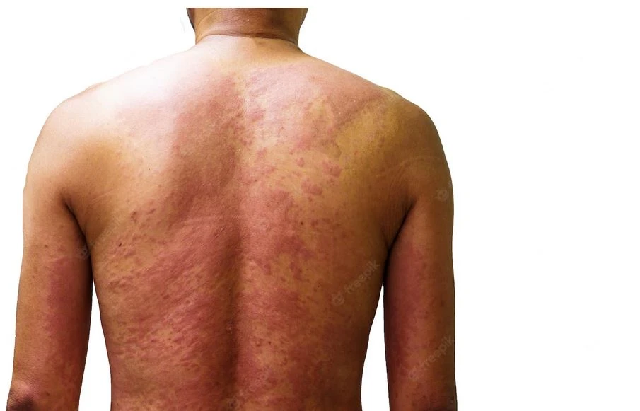 Reacción alérgica al fármaco Hombre Hinchazón de espalda con erupciones debido al fármaco