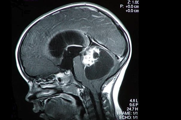 children brain tumors