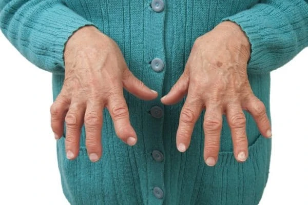 Investigación sobre la artritis reumatoide