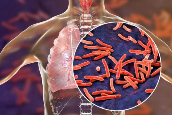 Investigación sobre la tuberculosis