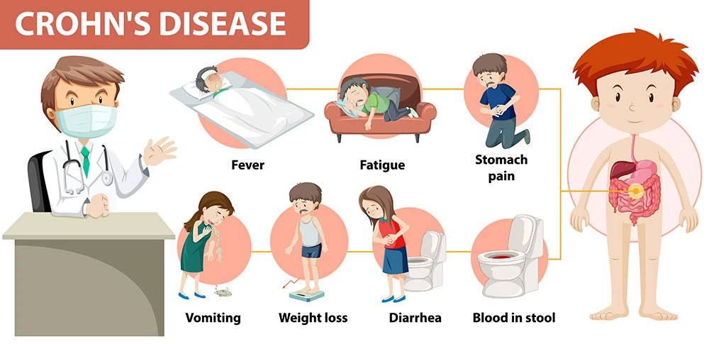 Ilustración de los síntomas y efectos de la enfermedad de Crohn