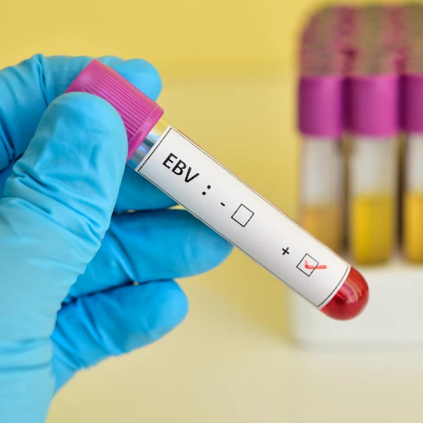 Epstein-Barr Virus (EBV)